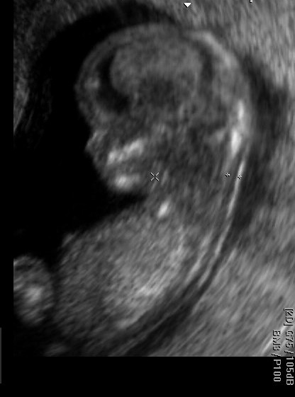 Embryo 13. SSW bei Ersttrimesterscreening